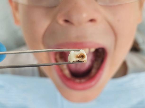 Best Emergency Tooth Extraction in Moody, AL