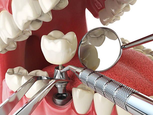 Best Emergency Root Canal Treatment in Moody, AL